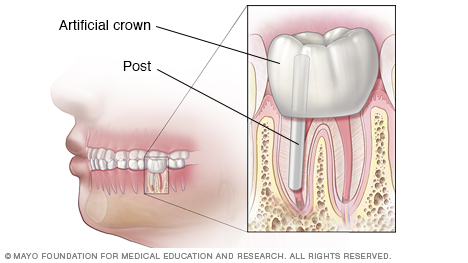牙根管治疗的最终结果和牙冠的图示