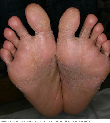 Photo showing dyshidrosis
