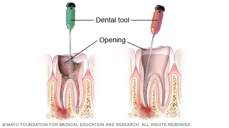 根管治疗时清除蛀牙的图示