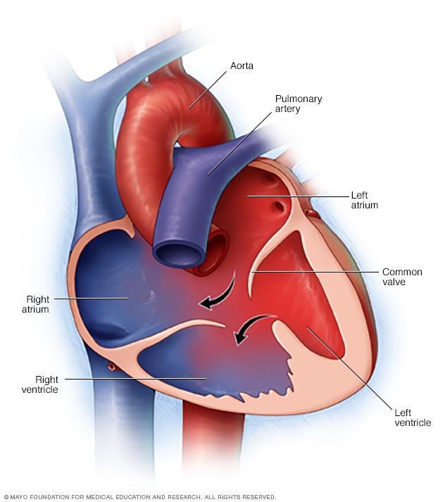 Illustration showing atrioventricular canal defect
