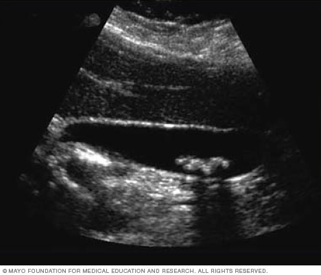 Ultrasound image of gallstones 
