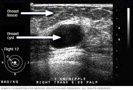 Ultrasound image of a breast cyst 
