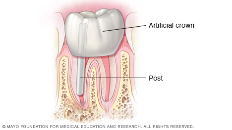 牙冠和牙齿恢复图示