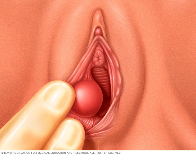 Illustration showing location of a Bartholin