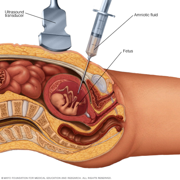 Amniocentesis