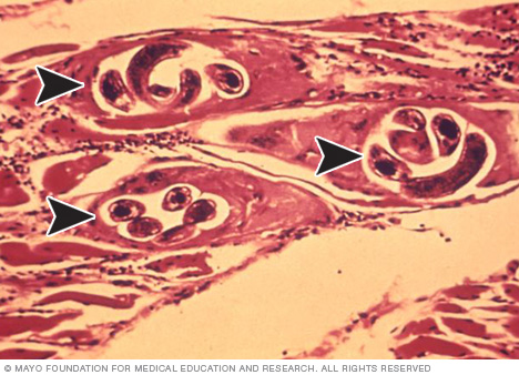 肌肉组织中旋毛虫囊肿的显微视图