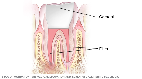 显示经填充的髓室和牙根管的图示
