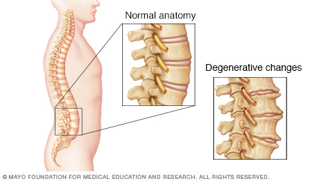 发生退行性病变的脊柱图示